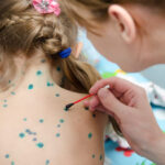 Вакцина Варицелла (Varicella)